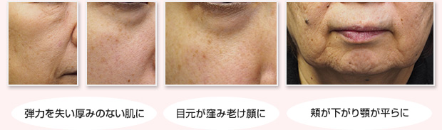 弾力を失い厚みのない肌に 目元が窪み老け顔に 頬が下がり顎が平らに
